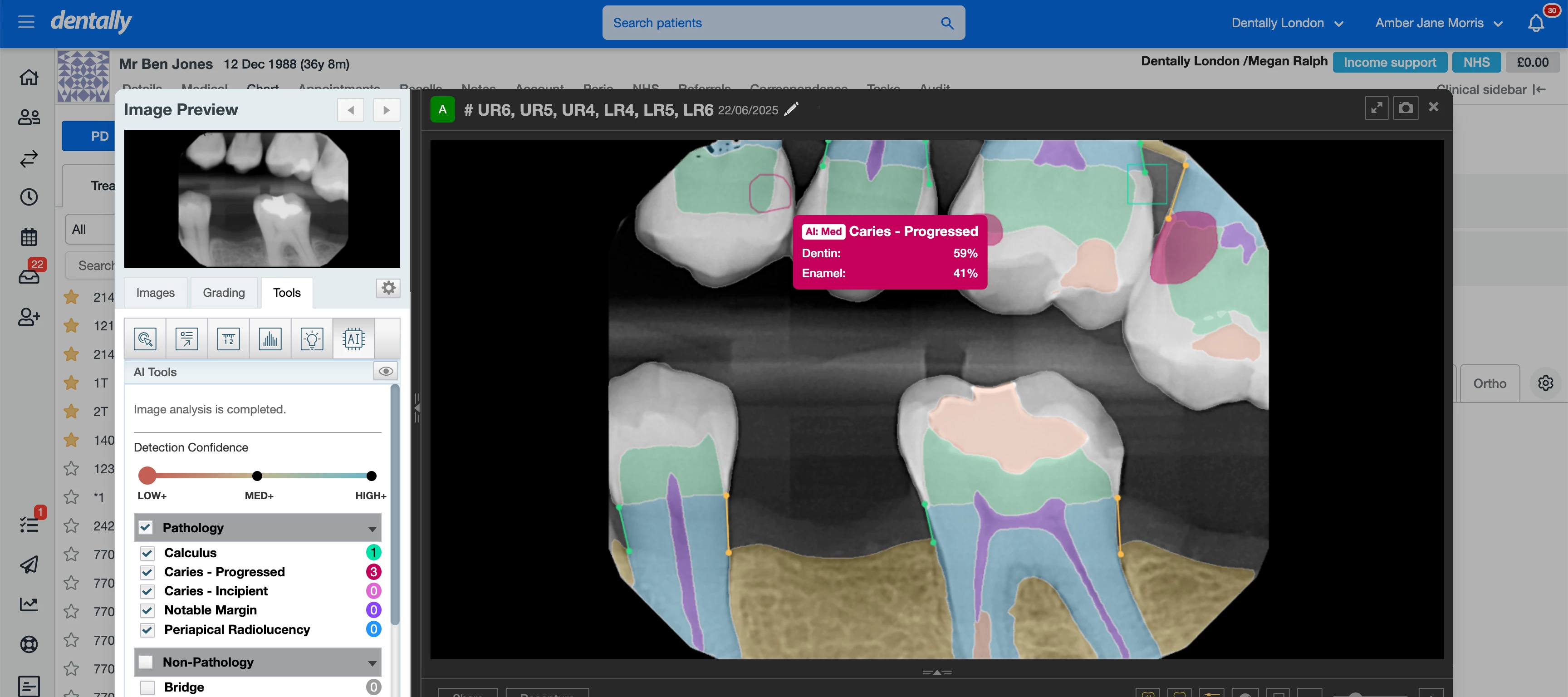 X ray bitewing with AI enhanced labels
